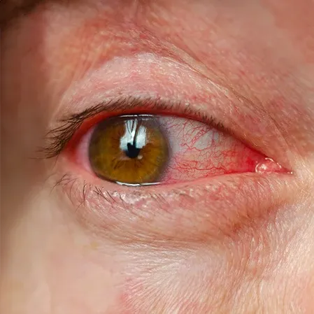 Pink Eye